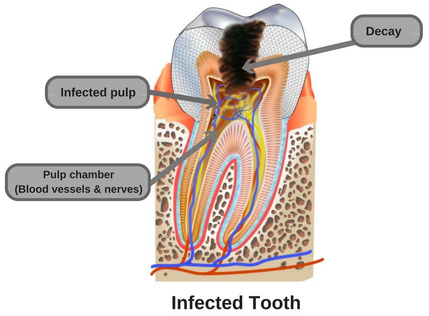 infected-tooth-decay