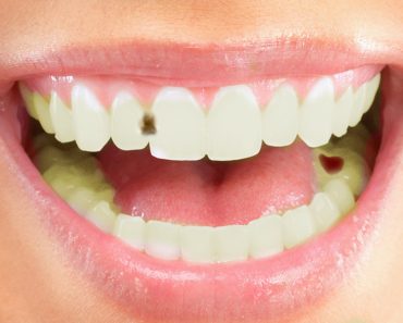 How Do Cavities Form In Teeth?