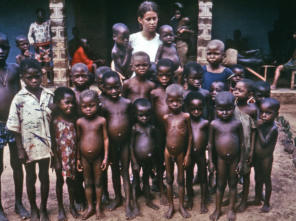 Kwashiorkor poor children