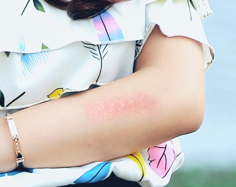 Woman hand on skin allergie