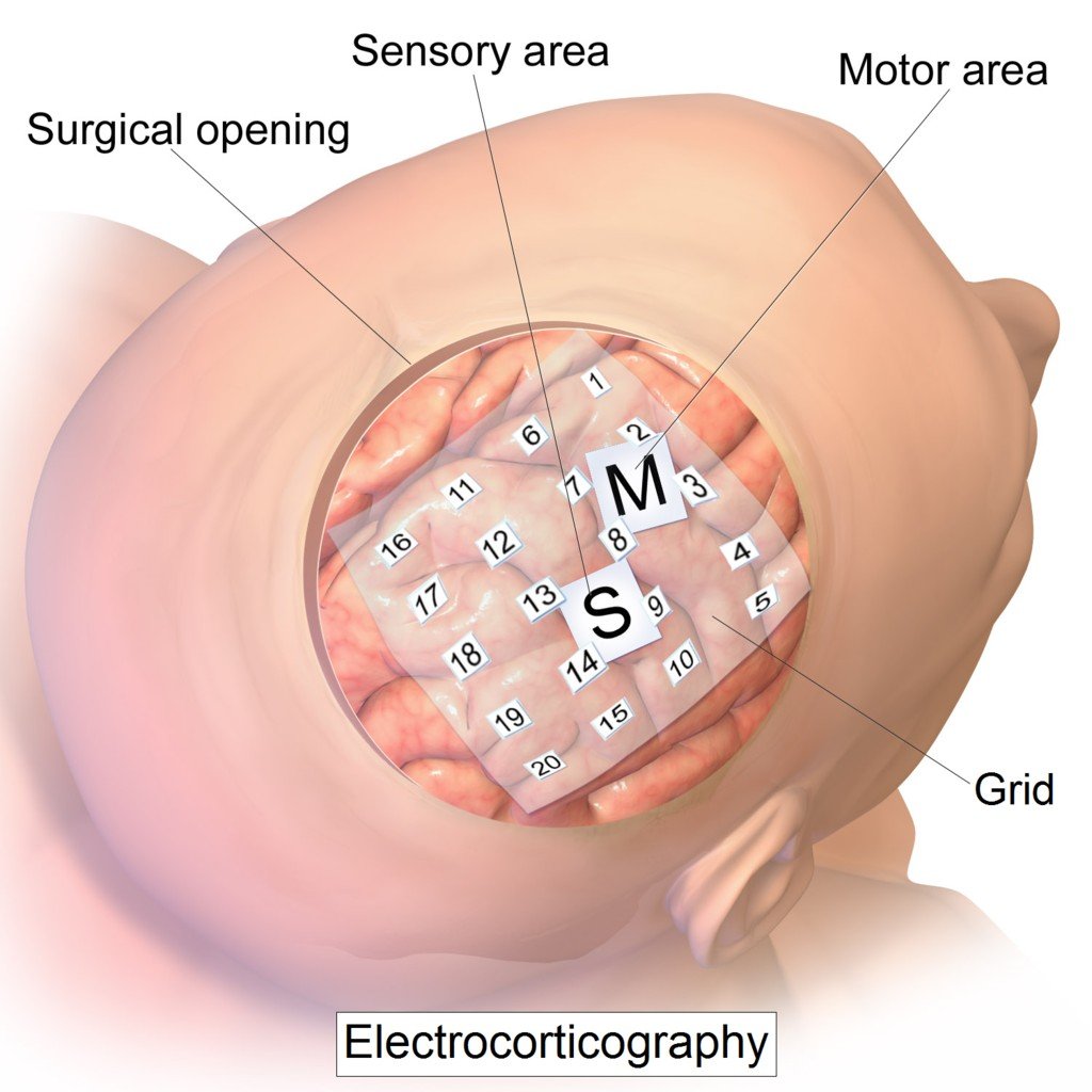 Intracranial electrode grid for electrocorticography