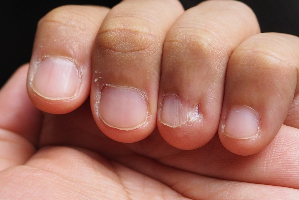 Closeup of fingers and nails bitten of a man. Health and medical concept - Image(topperspix)s