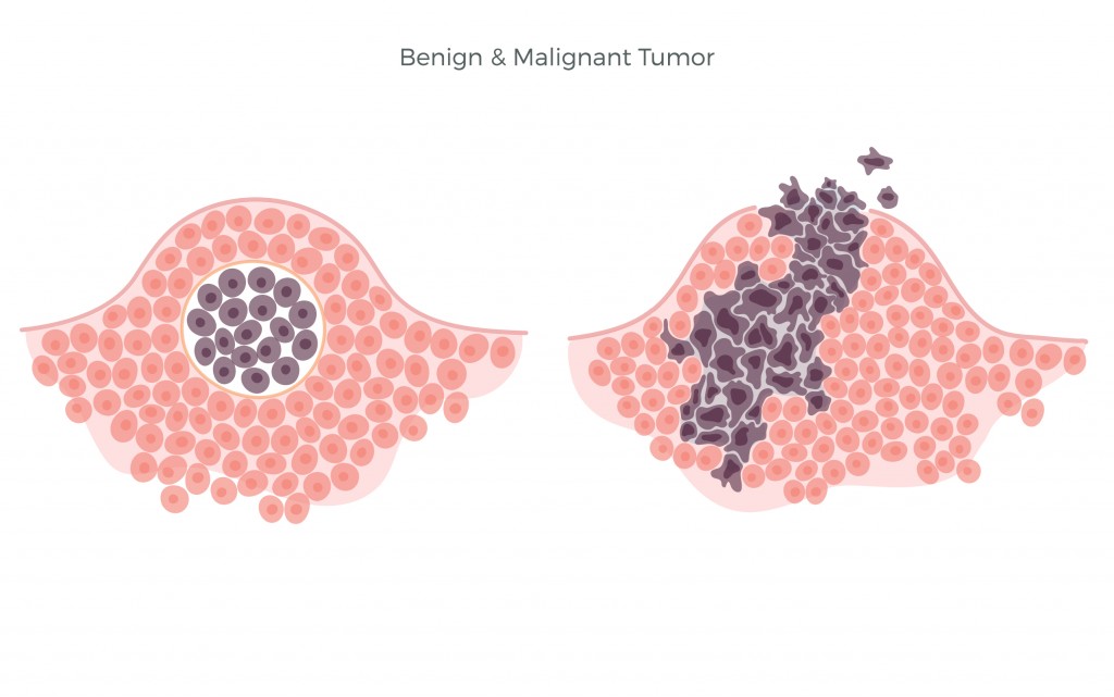 Vector isolated illustration of malignant and benign tumor in healthy tissue. Spreading of cancer cells, tumor development(Pikovit)s