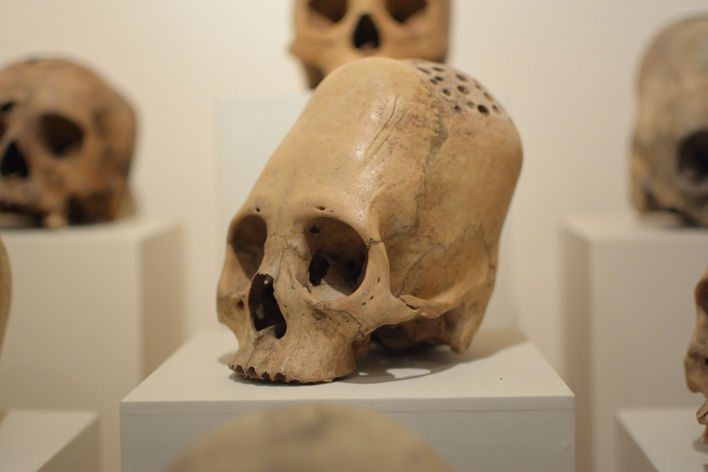 Elongated skulls of ancient Paracas people with evidences of surgical trepanation(TravelStrategy)s
