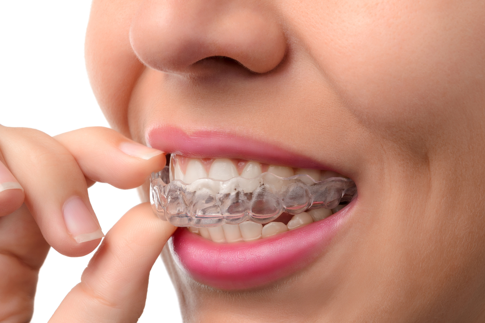 Woman wearing orthodontic silicone trainer. Invisible braces - Image(PavelSm)S