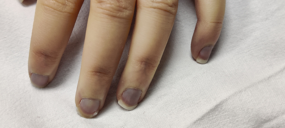 Acrocyanosis and purpura fulminans on distal finger(kris4to)s