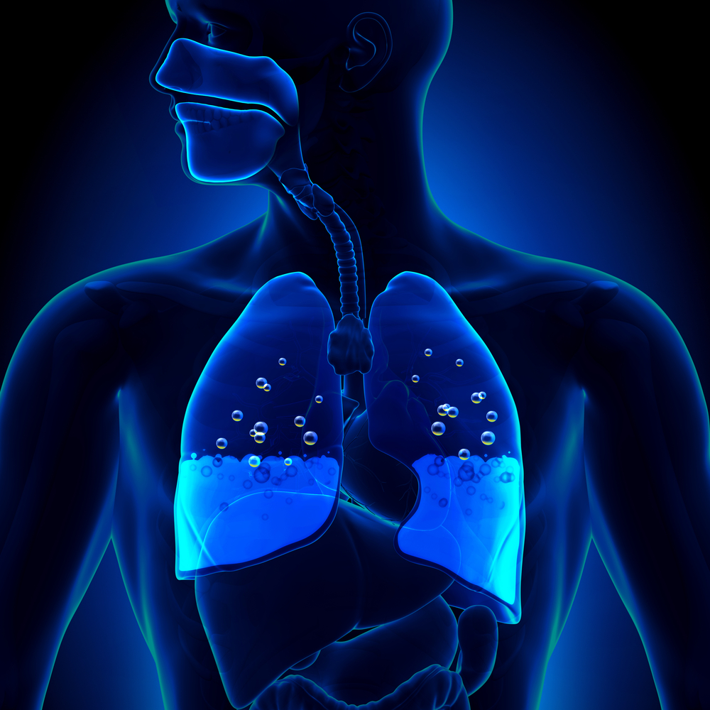Pulmonary Edema - Water in Lungs Anatomy(decade3d - anatomy online)S