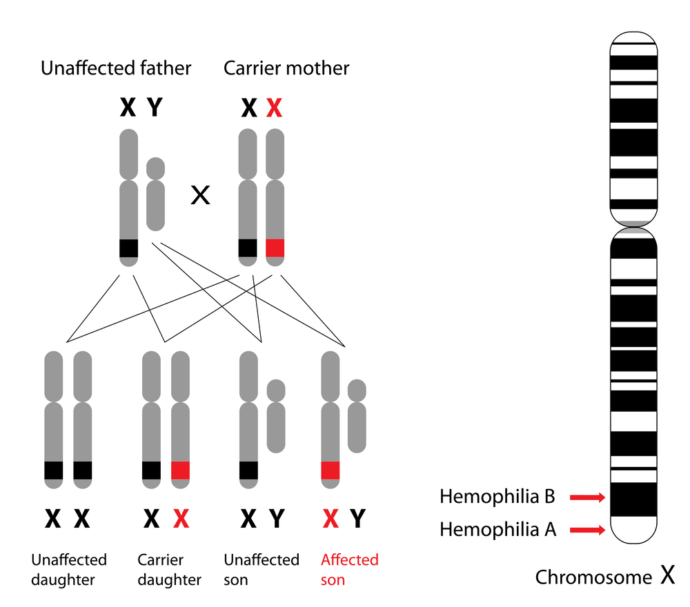 Genetics of hemophilia, A and B(Alila Medical Media)S
