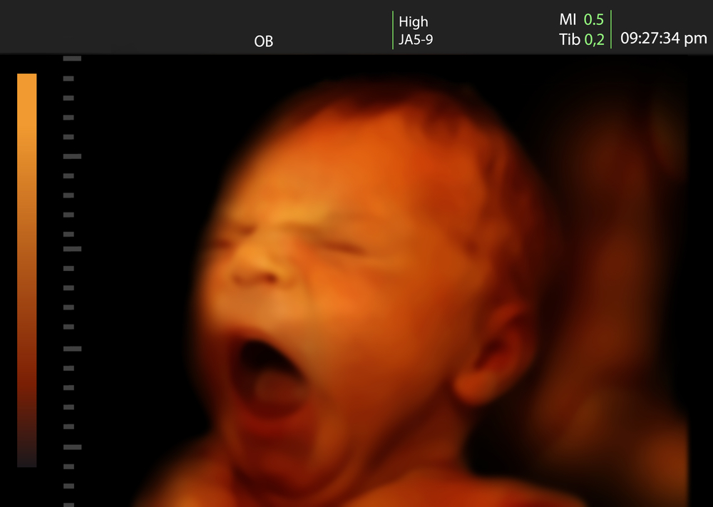 Image of a yawning newborn baby like 3D ultrasound of baby in mother's womb(Valentina Razumova)s