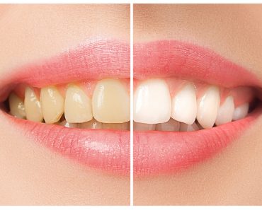 The female teeth before and after whitening(Master1305)s