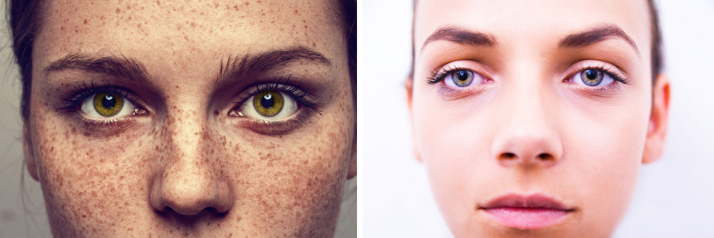 (Face freckles (dominant) vs No face freckles (recessive)