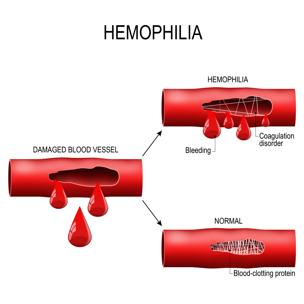 Hemophilia.,Damaged,Blood,Vessel,,Haemophilia,(coagulation,Disorder),And,Healthy,Blood