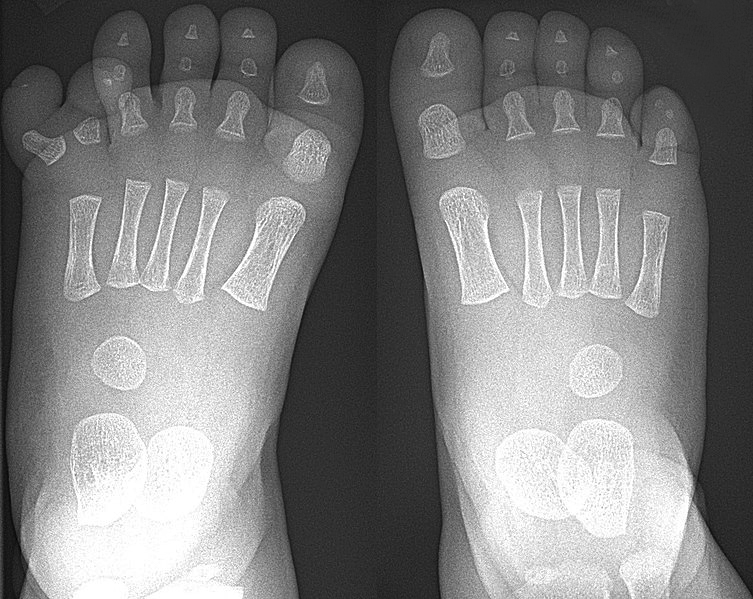 X-ray of feet in polydactyly