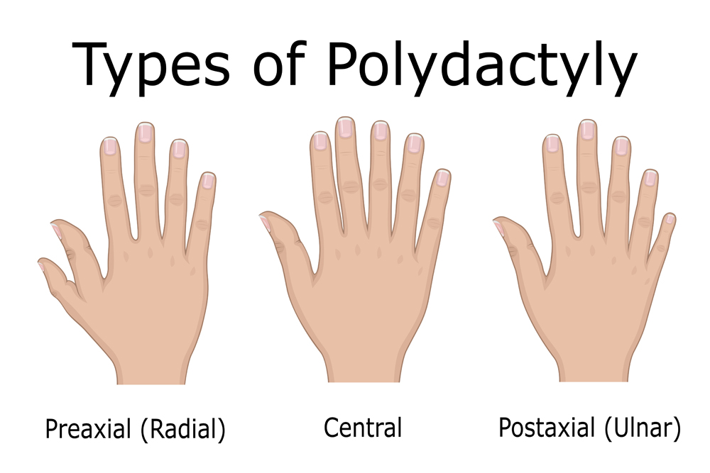 Illustration of three types of Polydactyly, such as Preaxial, Central and Postaxial