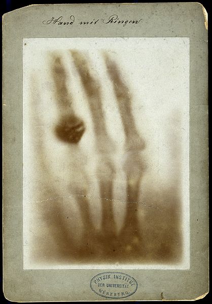 X-ray of the bones of a hand with a ring on one finger Wellcome