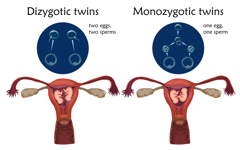 Multiple pregnancy. Dizygotic and monozygotic twins, embryo, fetus in uterus, placenta, umbilical cord, egg, sperm. Vector medical illustration. Colored image, white background.