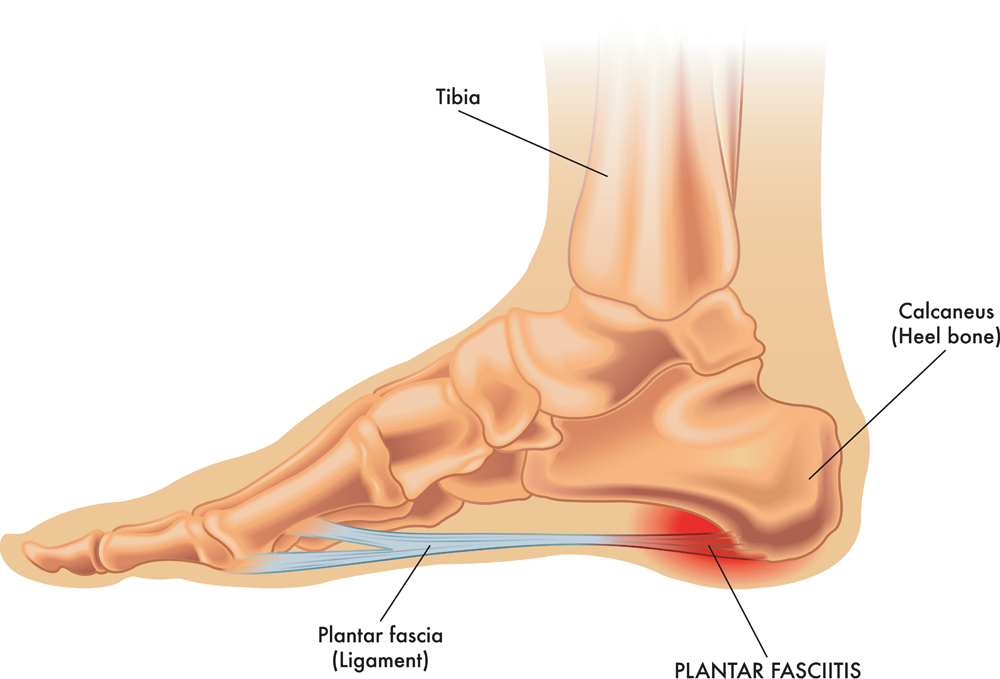 An illustration of the anatomy of a foot with the symptoms of plantar fasciitis.
